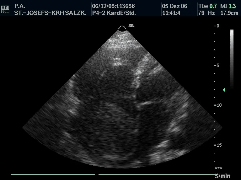 Echo-Loop — Im apikalen Vierkammerblick zeigt sich eine Raumforderung im rechten Vorhof.
Was ist die wahrscheinlichste Diagnose?