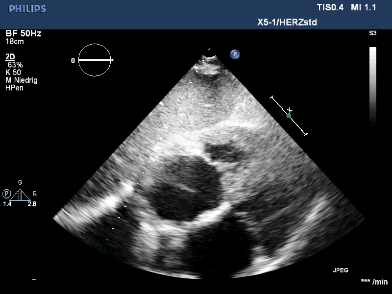 Echo loop — Parasternal long axis: septum/posterior wall 22/18 mm — diagnosis?