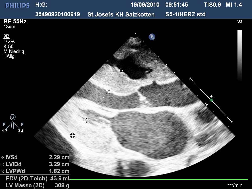 Echo loop 2 — Parasternal long axis: septum/posterior wall 22/18 mm — diagnosis?