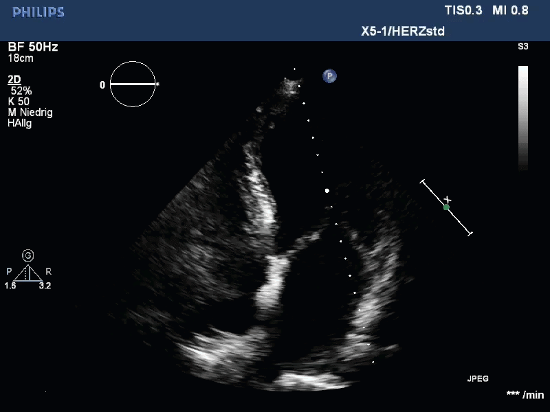 Echo loop — A 60-year-old woman presents with sudden-onset marked dyspnea. Echocardiography reveals severe mitral regurgitation. What is the most likely diagnosis?