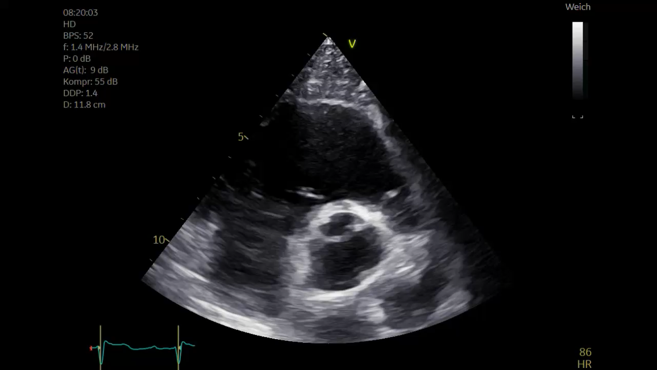 Echo loop — A 40-year-old woman presents with fever of unknown origin. Is the aortic valve morphologically normal?