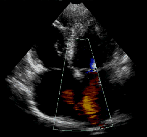 Echo loop — A 56-year-old patient with a known “heart defect since childhood” presents with increasing dyspnea. Is this a normal finding?