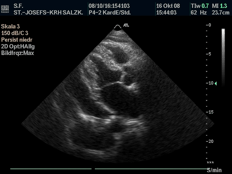 Echo loop — A 58-year-old patient with rheumatoid arthritis presents with pleuritic chest pain. What is the diagnosis?